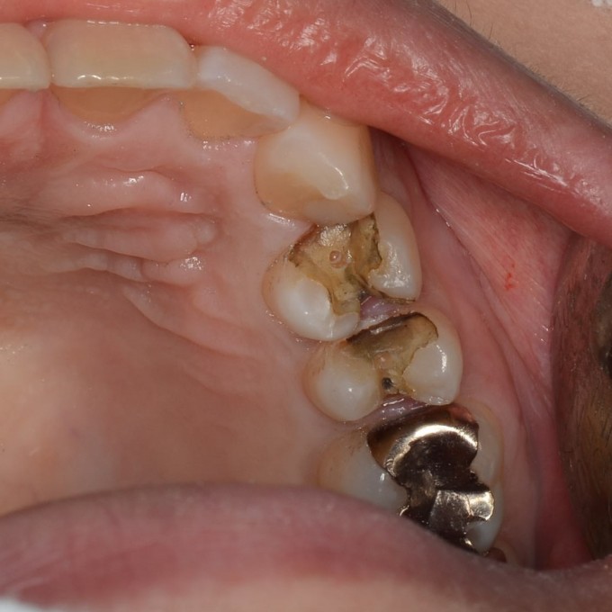 インレーの中の2次虫歯の銀歯を取った さいたま市見沼区ひまわり歯科