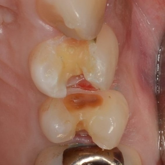銀歯の下の虫歯の見つけ方　軟化象牙質の除去中　見沼区のひまわり歯科