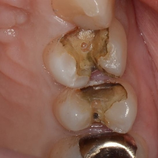 銀歯の下の虫歯の見つけ方　セメントが黒い　さいたま市見沼区の歯科